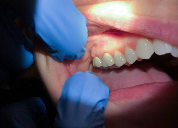 Best Emergency Treatment for Dental Infections or Abscesses in Bonduel, WI